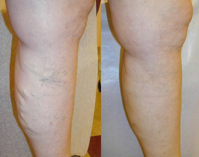 Spider vein removal Before and after