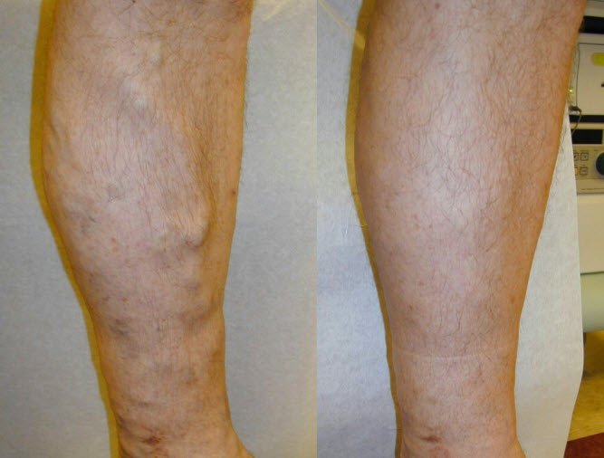 Varicose vein removal Before and after
